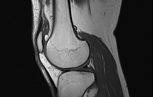 Xray photo of human knee joint in black and white